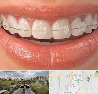 ارتودنسی اقساطی در یوسف آباد 