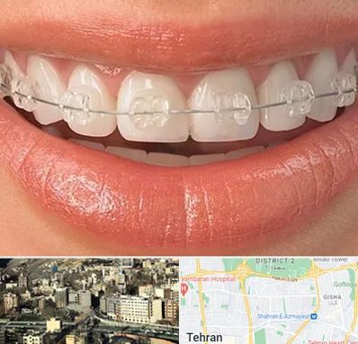 ارتودنسی اقساطی در مرزداران 