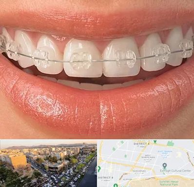 ارتودنسی اقساطی در تهرانپارس 