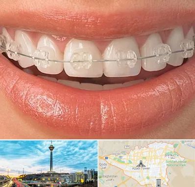 ارتودنسی اقساطی در تهران