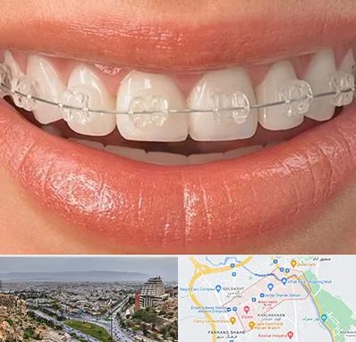 ارتودنسی اقساطی در معالی آباد شیراز 