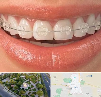 ارتودنسی اقساطی در کاشمر