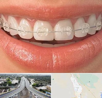 ارتودنسی اقساطی در اندیمشک