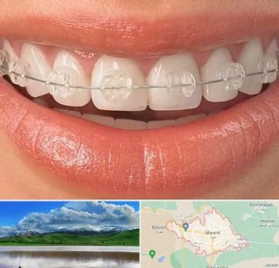 ارتودنسی اقساطی در مرند