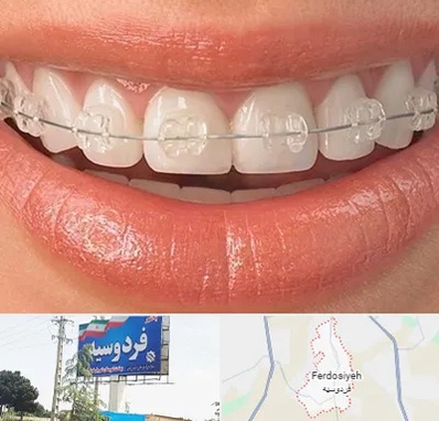 ارتودنسی اقساطی در فردوسیه شهریار