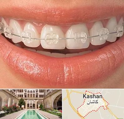 ارتودنسی اقساطی در کاشان