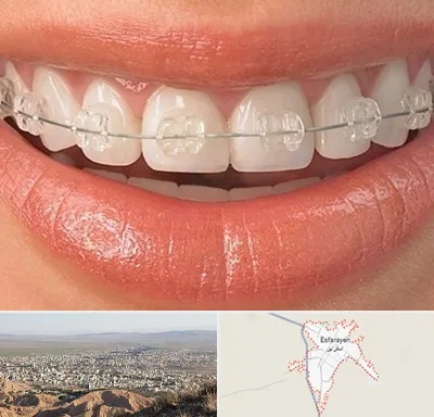 ارتودنسی اقساطی در اسفراین