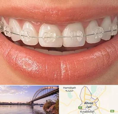 ارتودنسی اقساطی در اهواز
