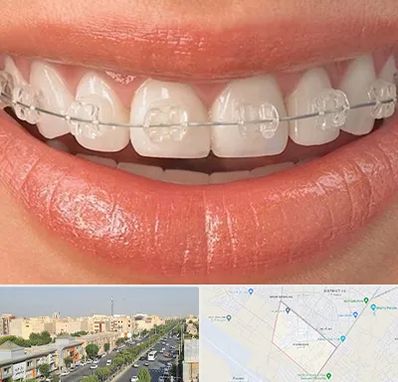 ارتودنسی اقساطی در کیانمهر کرج 