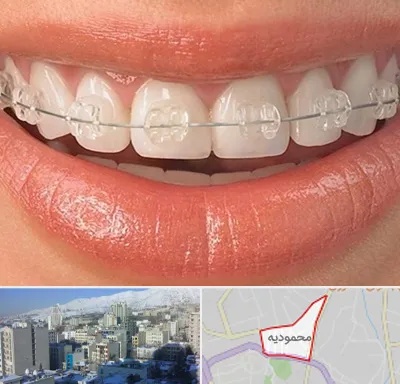 ارتودنسی اقساطی در محمودیه