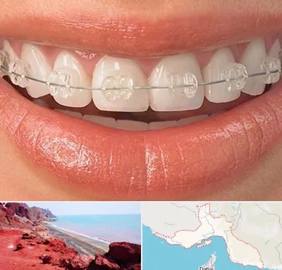 ارتودنسی اقساطی در هرمزگان