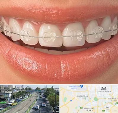 ارتودنسی اقساطی در جنوب تهران 