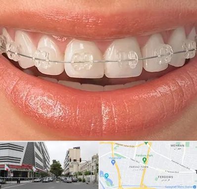 ارتودنسی اقساطی در بلوار فردوس 