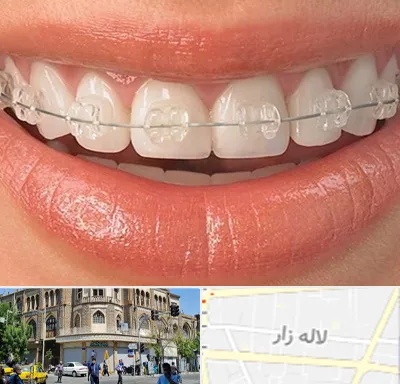 ارتودنسی اقساطی در لاله زار