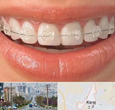 ارتودنسی اقساطی در گوهردشت کرج 