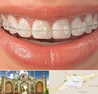 ارتودنسی اقساطی در سمنان