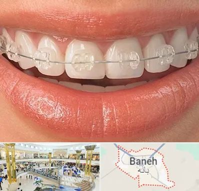 ارتودنسی اقساطی در بانه