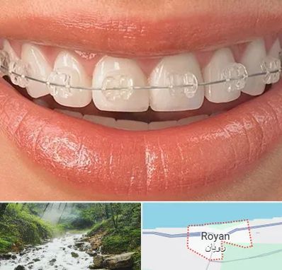 ارتودنسی اقساطی در رویان