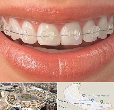 ارتودنسی اقساطی در پرند