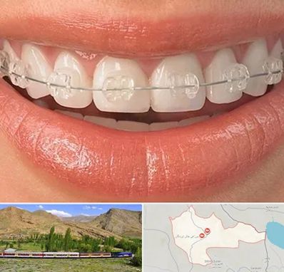 ارتودنسی اقساطی در خاش