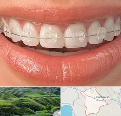ارتودنسی اقساطی در گچساران