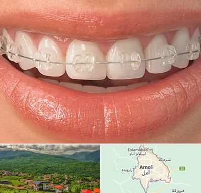 ارتودنسی اقساطی در آمل