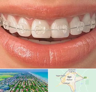 ارتودنسی اقساطی در ساری