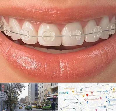 ارتودنسی اقساطی در فاطمی 