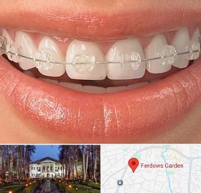 ارتودنسی اقساطی در باغ فردوس