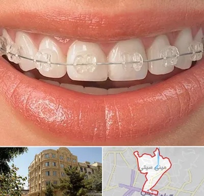 ارتودنسی اقساطی در مینی سیتی