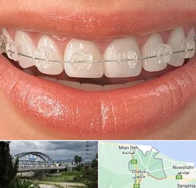 ارتودنسی اقساطی در چالوس
