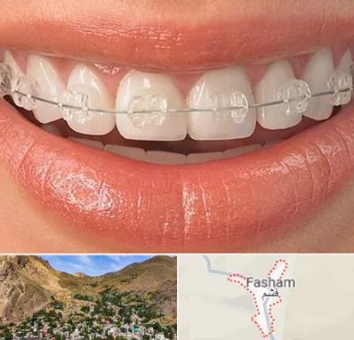 ارتودنسی اقساطی در فشم