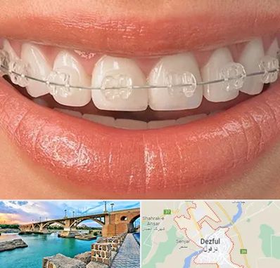 ارتودنسی اقساطی در دزفول