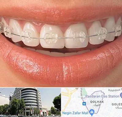 ارتودنسی اقساطی در قلهک 