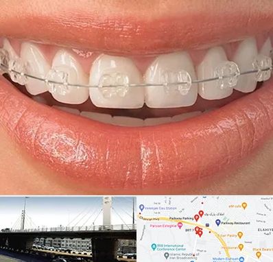 ارتودنسی اقساطی در پارک وی 