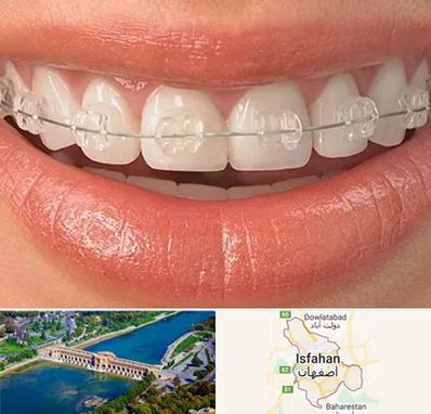 ارتودنسی اقساطی در اصفهان
