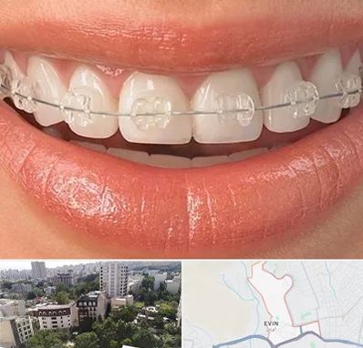 ارتودنسی اقساطی در اوین