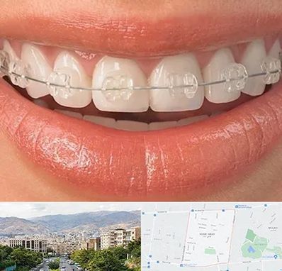 ارتودنسی اقساطی در خانی آباد 