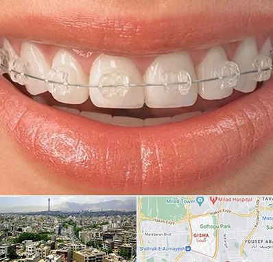 ارتودنسی اقساطی در گیشا 