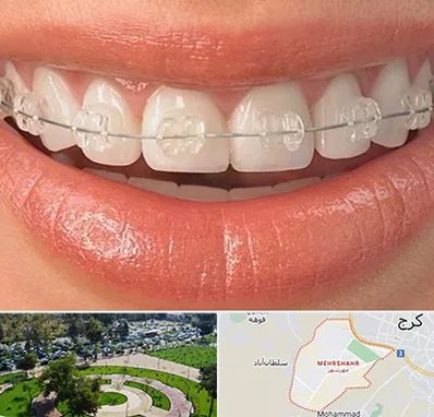 ارتودنسی اقساطی در مهرشهر کرج 