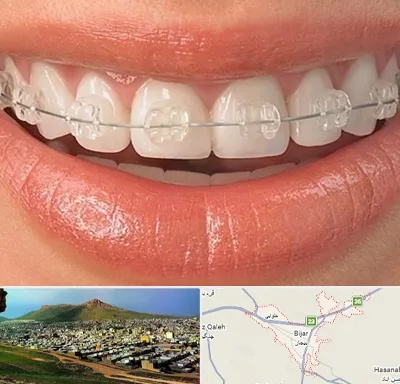 ارتودنسی اقساطی در بیجار