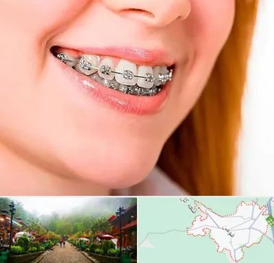 ارتودنسی ارزان در فومن