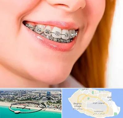 ارتودنسی ارزان در کیش