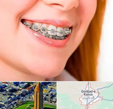 ارتودنسی ارزان در گنبد کاووس
