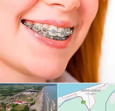 ارتودنسی ارزان در محمودآباد
