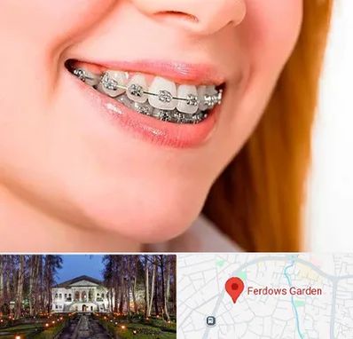 ارتودنسی ارزان در باغ فردوس
