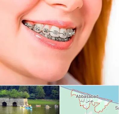 ارتودنسی ارزان در عباس آباد