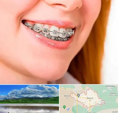 ارتودنسی ارزان در مرند