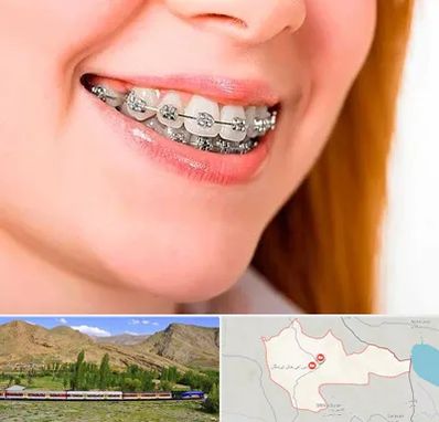 ارتودنسی ارزان در خاش