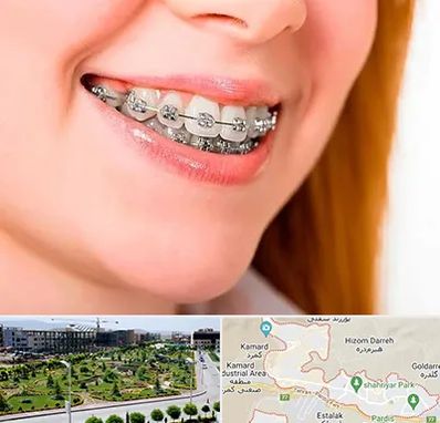 ارتودنسی ارزان در پردیس